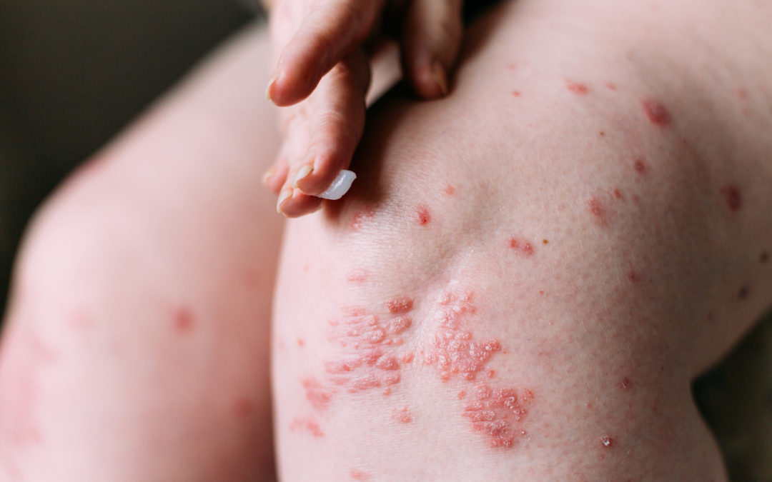What Skin Disorders Can Be Inherited?