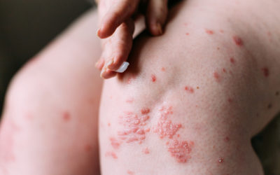 What Skin Disorders Can Be Inherited?