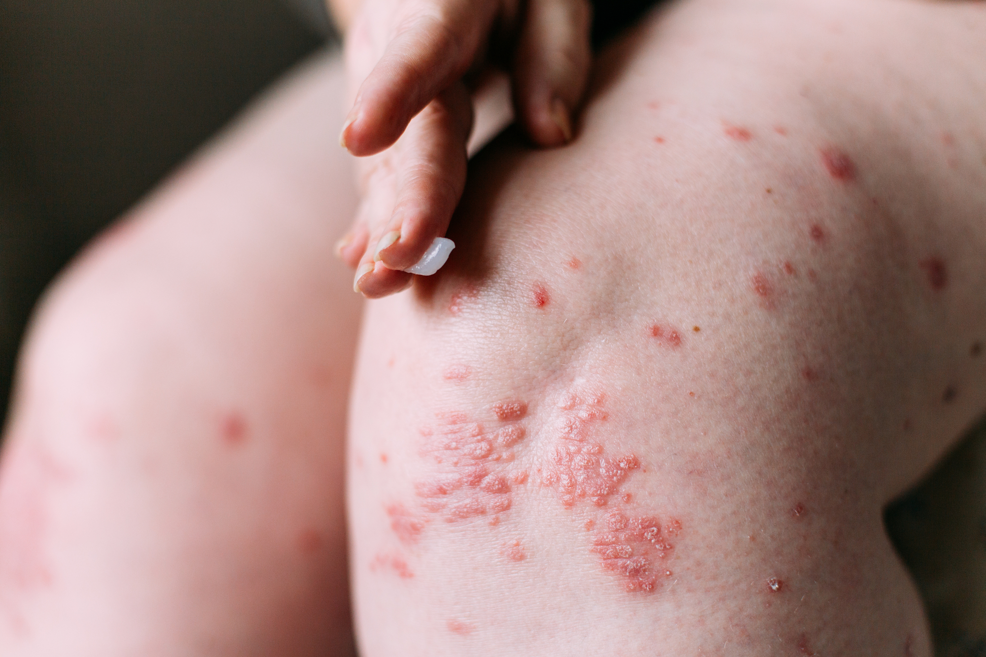 What Skin Disorders Can Be Inherited?
